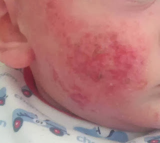 What is Red Skin Syndrome?